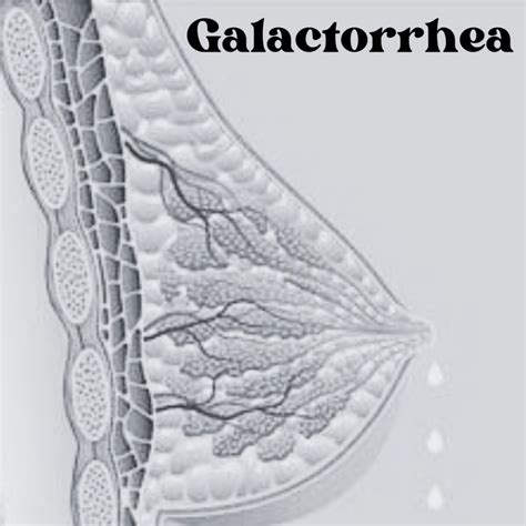 Galactorrhea